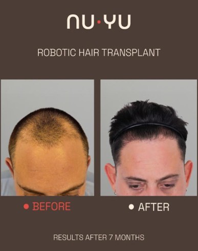 NUYU מרפאת שיער